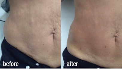 Фотона Боди 5